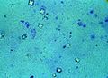 Calcium oxalate crystals in urine.jpg
