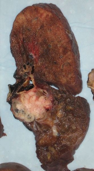 Soubor:Lung cancer.jpg