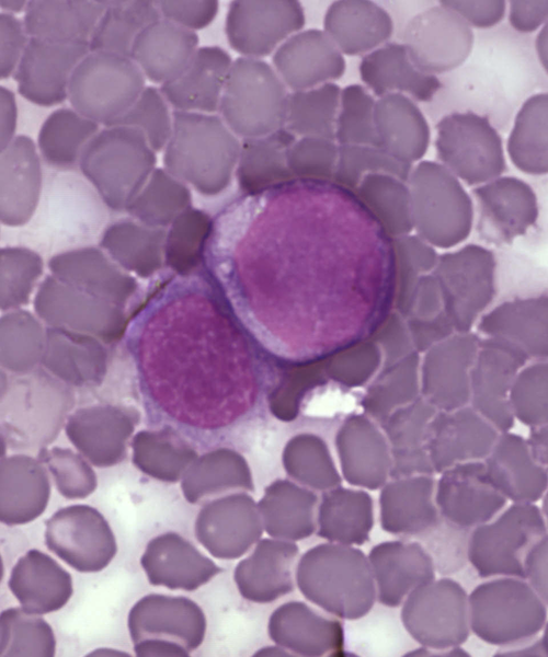 Soubor:Leukemia cells.png