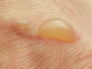 Blister from burns (top).png