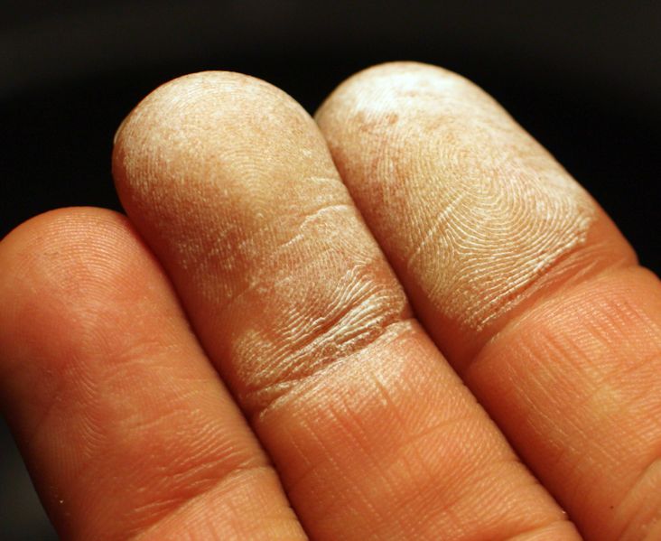 Soubor:Hydrogen peroxide 35 percent on skin.jpg