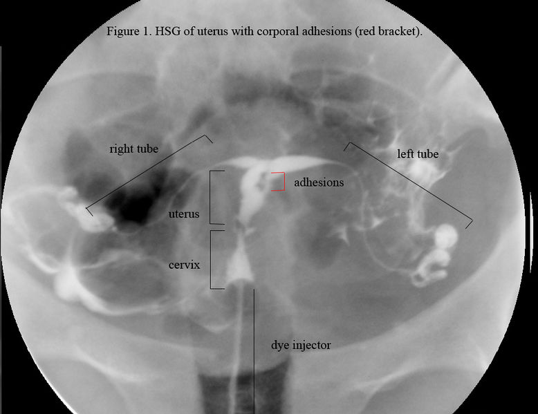 Soubor:HSG Ashermans syndrome.jpg