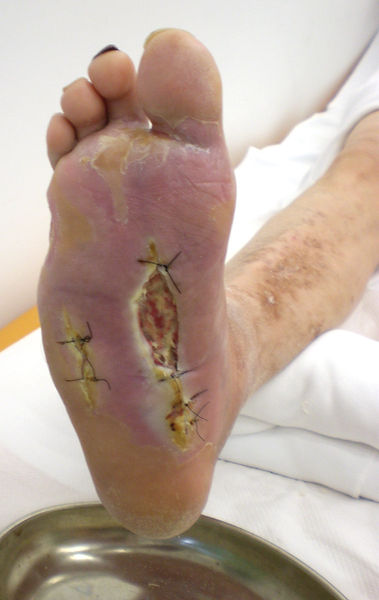 Soubor:Diabetic Foot Syndrome.jpg