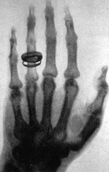 Soubor:X-ray by Wilhelm Röntgen of Albert von Kölliker's hand - 18960123-02.jpg